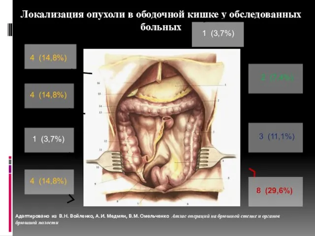 Локализация опухоли в ободочной кишке у обследованных больных 1 (3,7%) 4 (14,8%)