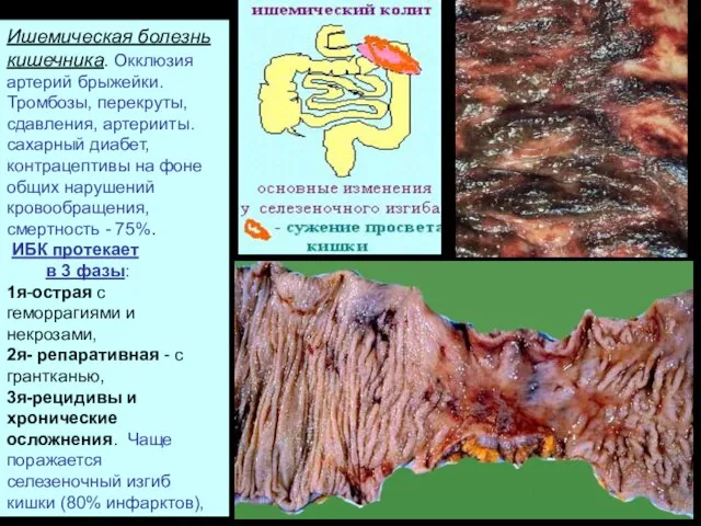 Ишемическая болезнь кишечника. Окклюзия артерий брыжейки. Тромбозы, перекруты, сдавления, артерииты. сахарный диабет,