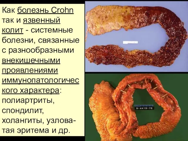 Как болезнь Crohn так и язвенный колит - системные болезни, связанные с