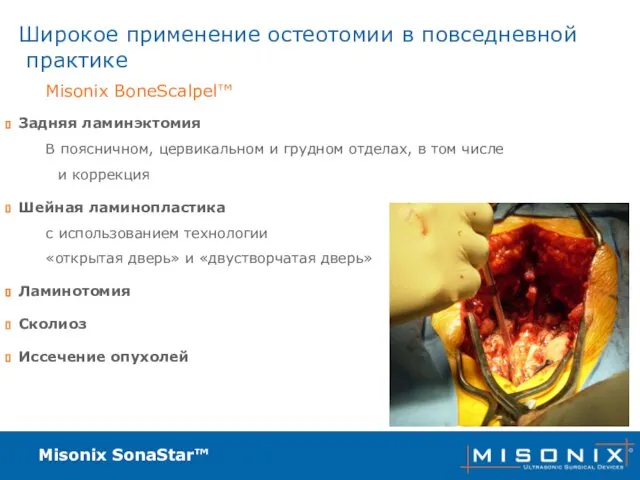 Misonix SonaStar™ Широкое применение остеотомии в повседневной практике Задняя ламинэктомия В поясничном,