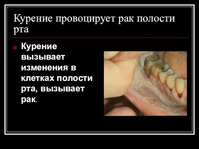 Курение провоцирует рак полости рта Курение вызывает изменения в клетках полости рта, вызывает рак.