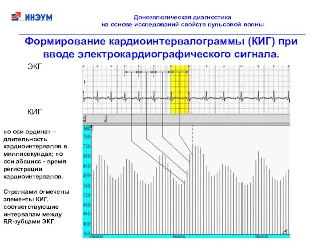 Формирование кардиоинтервалограммы (КИГ) при вводе электрокардиографического сигнала. ЭКГ КИГ по оси ординат