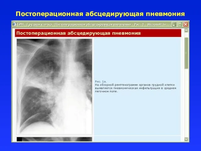 Постоперационная абсцедирующая пневмония