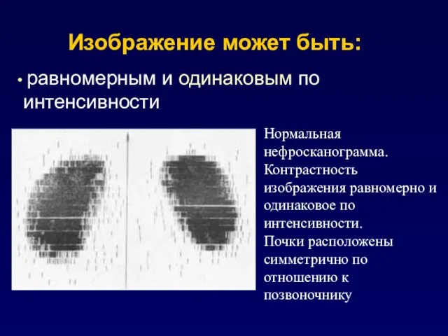 Изображение может быть: равномерным и одинаковым по интенсивности Нормальная нефросканограмма. Контрастность изображения