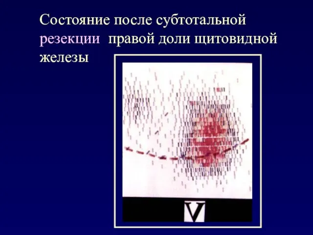 Состояние после субтотальной резекции правой доли щитовидной железы