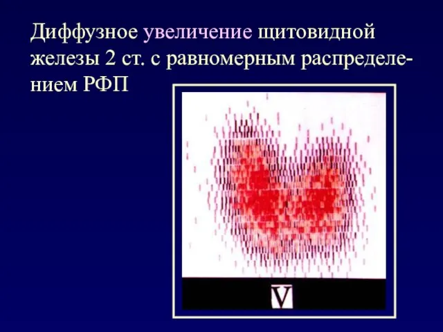 Диффузное увеличение щитовидной железы 2 ст. с равномерным распределе-нием РФП