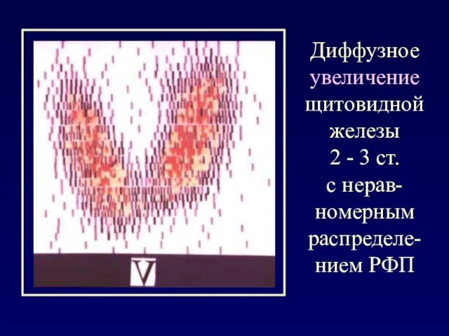 Диффузное увеличение щитовидной железы 2 - 3 ст. с нерав-номерным распределе-нием РФП