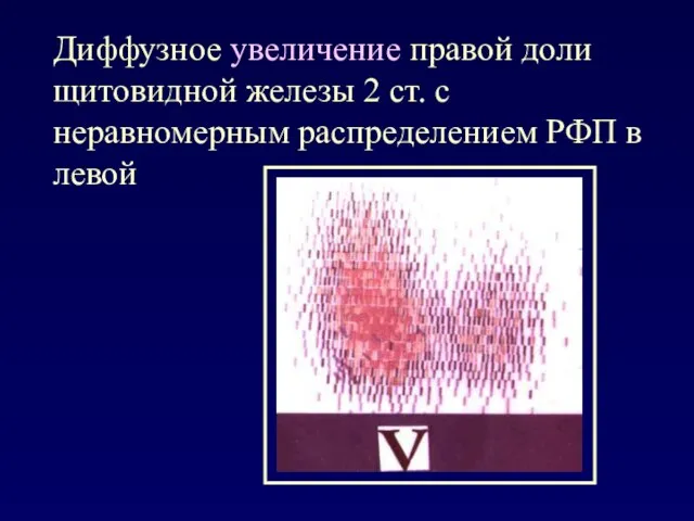 Диффузное увеличение правой доли щитовидной железы 2 ст. с неравномерным распределением РФП в левой