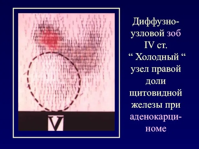 Диффузно-узловой зоб IV ст. “ Холодный “ узел правой доли щитовидной железы при аденокарци-номе