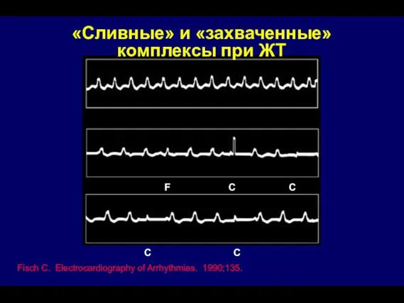 «Сливные» и «захваченные» комплексы при ЖТ Fisch C. Electrocardiography of Arrhythmias. 1990;135.