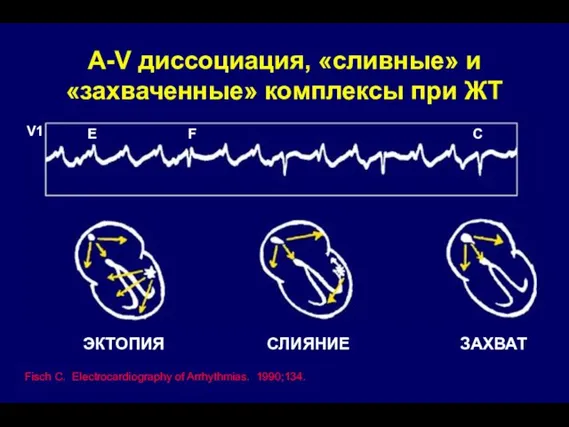 A-V диссоциация, «сливные» и «захваченные» комплексы при ЖТ Fisch C. Electrocardiography of