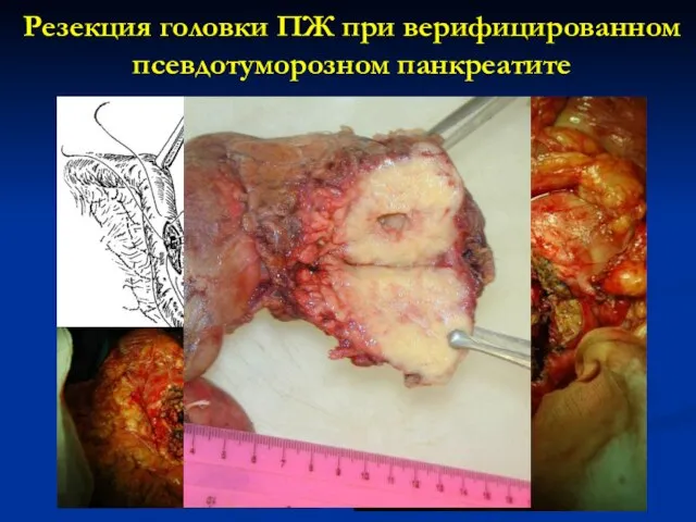 Резекция головки ПЖ при верифицированном псевдотуморозном панкреатите
