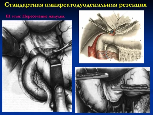 Стандартная панкреатодуоденальная резекция III этап: Пересечение желудка.