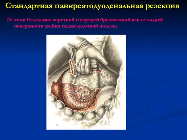 Стандартная панкреатодуоденальная резекция IV этап: Отделение воротной и верхней брыжеечной вен от