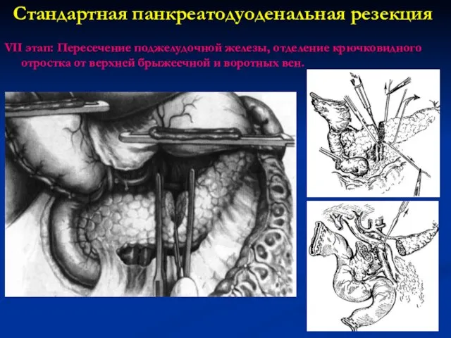 Стандартная панкреатодуоденальная резекция VII этап: Пересечение поджелудочной железы, отделение крючковидного отростка от