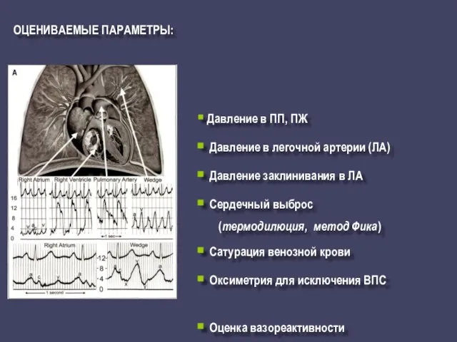 ОЦЕНИВАЕМЫЕ ПАРАМЕТРЫ: Давление в ПП, ПЖ Давление в легочной артерии (ЛА) Давление