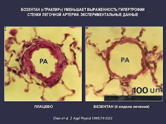 Chen et al. J Appl Physiol 1995;79:2122 ПЛАЦЕБО БЕЗЕНТАН (4 недели лечения)