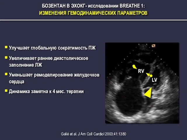 БОЗЕНТАН В ЭХОКГ- исследовании BREATHE 1: ИЗМЕНЕНИЯ ГЕМОДИНАМИЧЕСКИХ ПАРАМЕТРОВ Улучшает глобальную сократимость