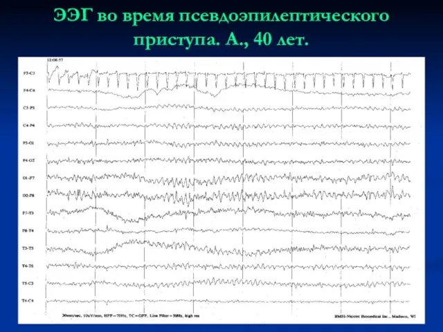 ЭЭГ во время псевдоэпилептического приступа. А., 40 лет.