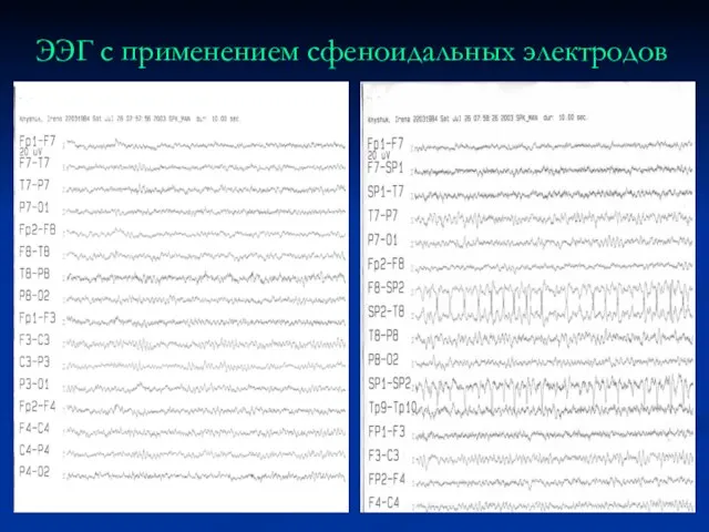 ЭЭГ с применением сфеноидальных электродов