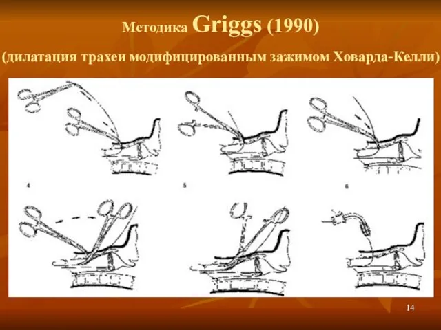 Методика Griggs (1990) (дилатация трахеи модифицированным зажимом Ховарда-Келли)