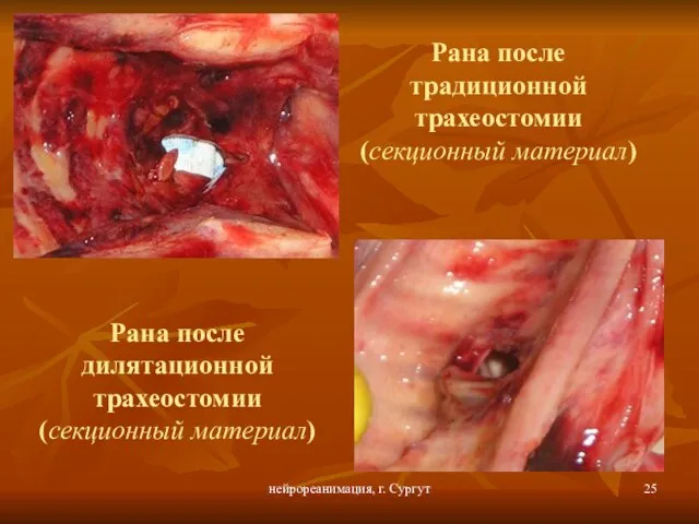 нейрореанимация, г. Сургут Рана после традиционной трахеостомии (секционный материал) Рана после дилятационной трахеостомии (секционный материал)