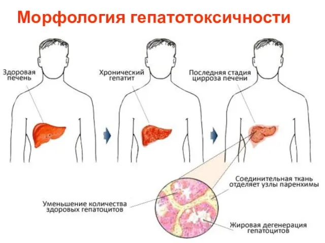 Морфология гепатотоксичности