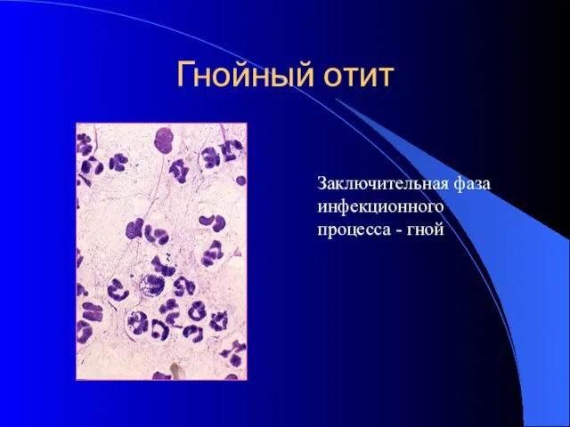 Гнойный отит Заключительная фаза инфекционного процесса - гной