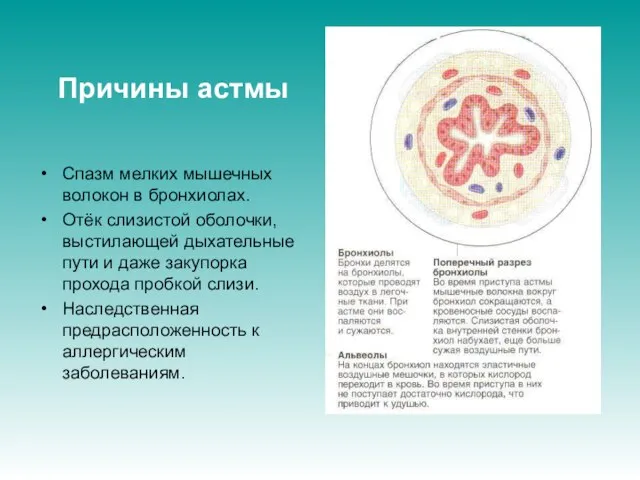 Причины астмы Спазм мелких мышечных волокон в бронхиолах. Отёк слизистой оболочки, выстилающей