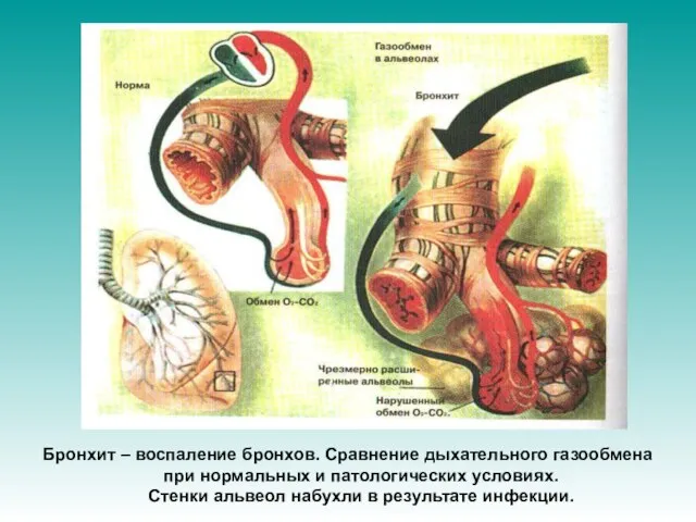 Бронхит – воспаление бронхов. Сравнение дыхательного газообмена при нормальных и патологических условиях.