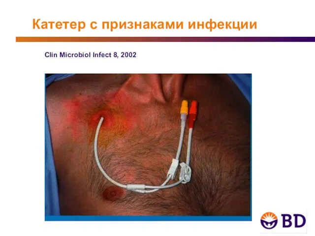 Катетер с признаками инфекции Clin Microbiol Infect 8, 2002