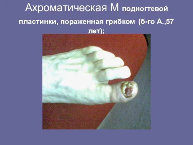 Ахроматическая М подногтевой пластинки, пораженная грибком (б-го А.,57 лет);