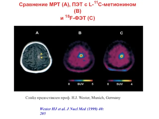 Сравнение МРТ (А), ПЭТ с L-11C-метионином (В) и 18F-ФЭТ (С) Слайд предоставлен