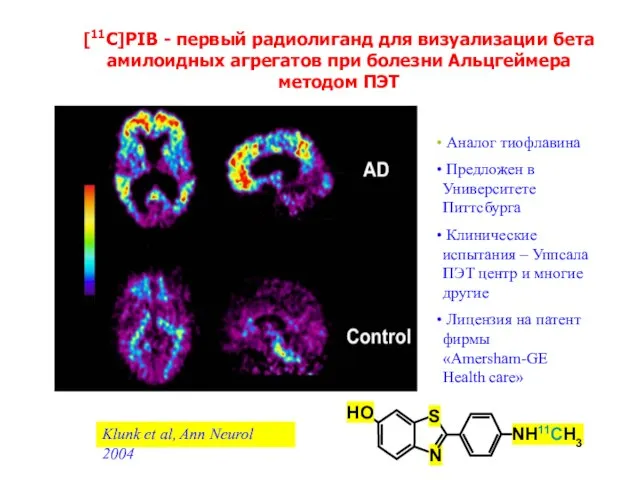 [11C]PIB - первый радиолиганд для визуализации бета амилоидных aгрегaтoв при болезни Альцгеймера