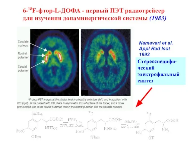 6-18F-фтор-L-ДОФА - первый ПЭТ радиотрейсер для изучения допаминергической системы (1983) Стереоспецифи- ческий