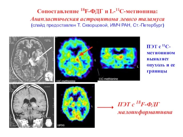 ПЭТ с 11С-метионином выявляет опухоль и ее границы Сопоставление 18F-ФДГ и L-11C-метионина: