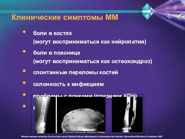 Клинические симптомы ММ боли в костях (могут восприниматься как нейропатия) боли в
