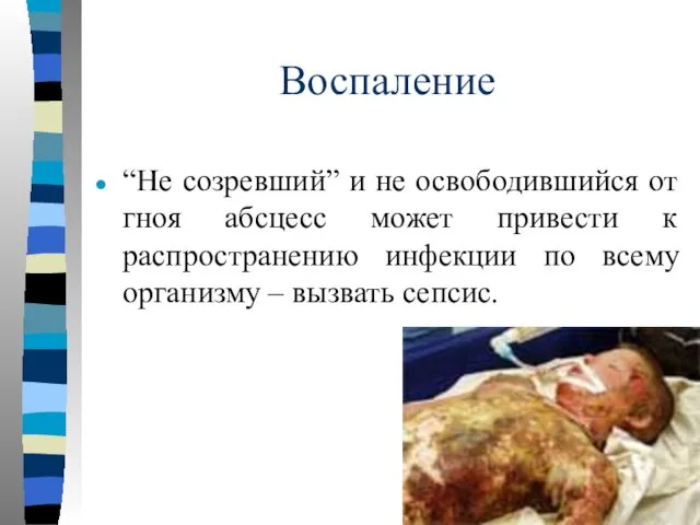 Воспаление “Не созревший” и не освободившийся от гноя абсцесс может привести к