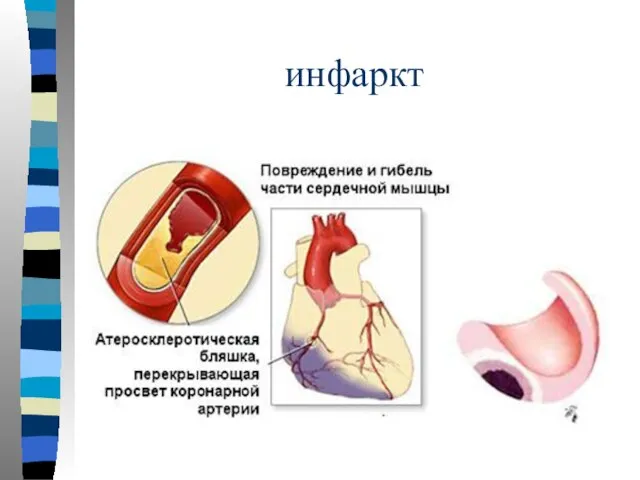 инфаркт