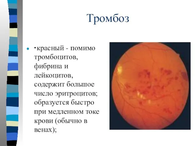 Тромбоз ∙ красный - помимо тромбоцитов, фибрина и лейкоцитов, содержит большое число