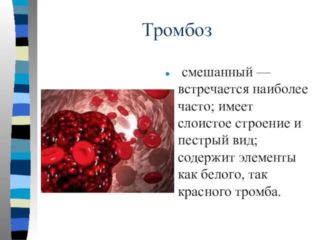 Тромбоз смешанный — встречается наиболее часто; имеет слоистое строение и пестрый вид;