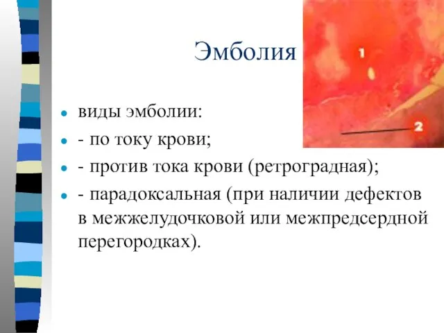 Эмболия виды эмболии: - по току крови; - против тока крови (ретроградная);