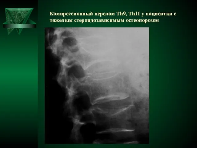 Компрессионный перелом Th9, Th11 у пациентки с тяжелым стероидозависимым остеопорозом