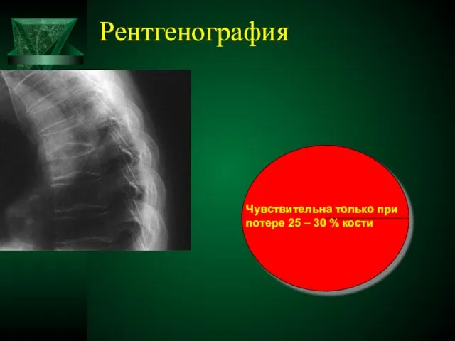Рентгенография Чувствительна только при потере 25 – 30 % кости