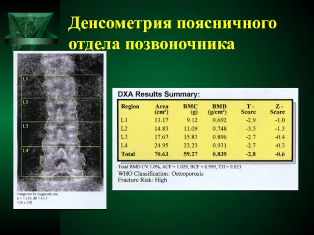 Денсометрия поясничного отдела позвоночника