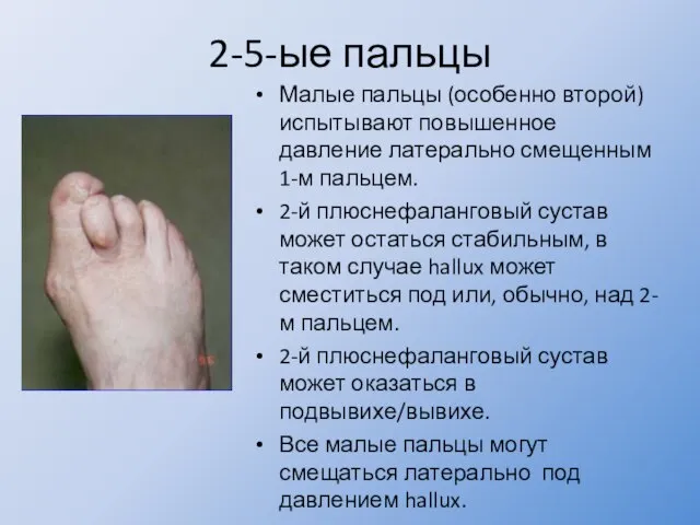 2-5-ые пальцы Малые пальцы (особенно второй) испытывают повышенное давление латерально смещенным 1-м