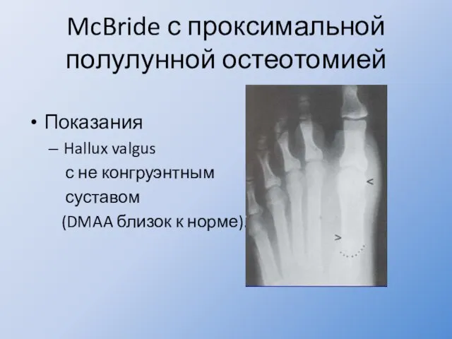 McBride с проксимальной полулунной остеотомией Показания Hallux valgus с не конгруэнтным суставом (DMAA близок к норме).