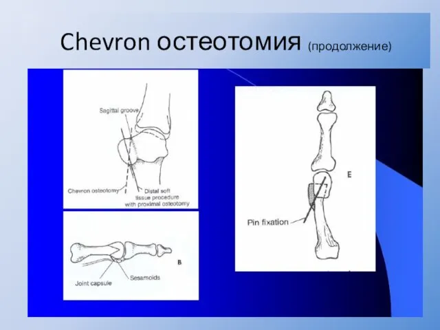 Chevron остеотомия (продолжение)
