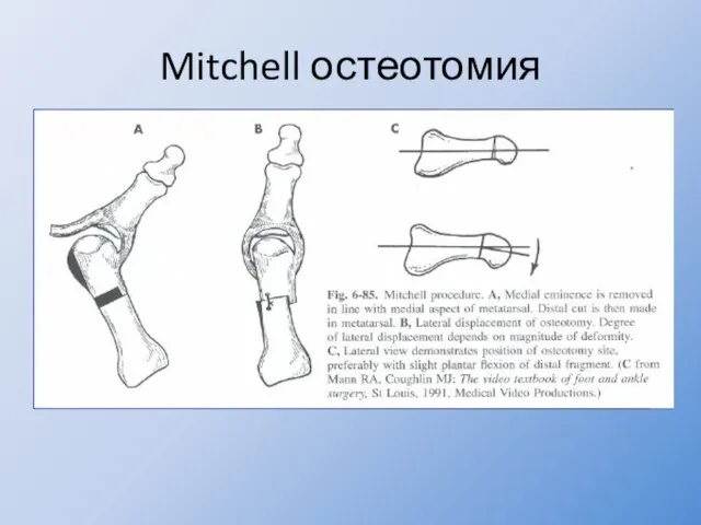 Mitchell остеотомия