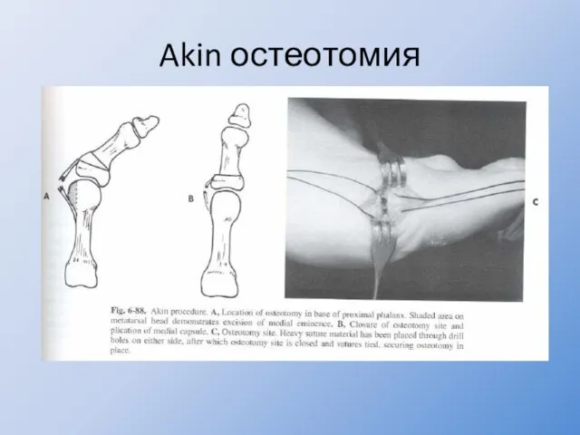 Akin остеотомия